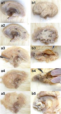 White matter changes in fetal brains with ventriculomegaly